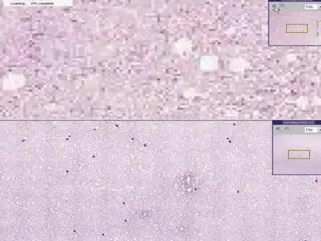 Blood - Chronic Lymphocytic Leukemia