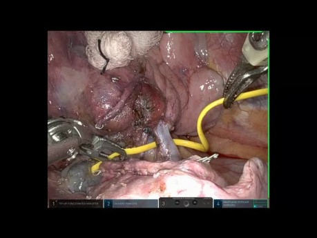 Robotic Middle Lobectomy