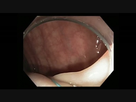 Colonoscopy - Sigmoid Polyp 4 - Loop ligation