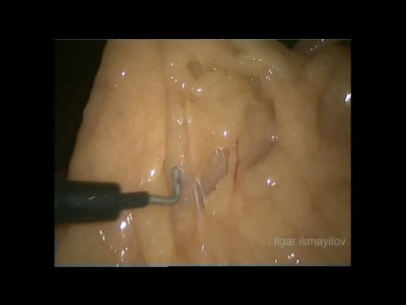 Laparoscopic Very Low Anterior Resection for Supra Anal Rectal Cancer