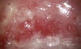 Colposcopy - CIN3