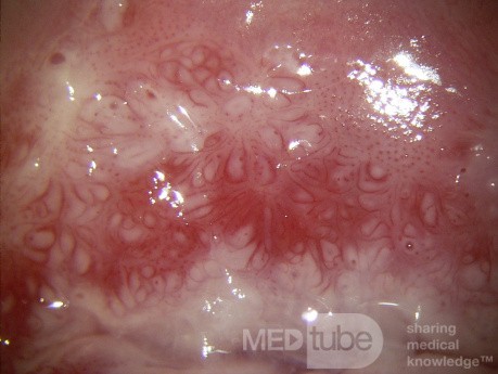 Colposcopy - CIN3