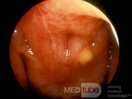 Thornwadlt's Sinus
