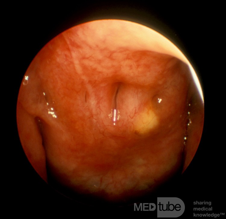 Thornwadlt's Sinus