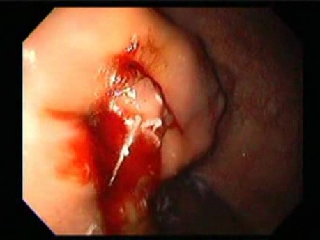 Gastric Varices - Endoscopic Ablation With Cyanoacrylate Glue (10 of 18)
