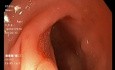 Sessile Polyp Cold Snaring