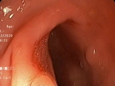 Sessile Polyp Cold Snaring