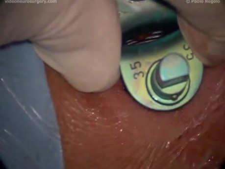 Cervical Microdiscectomy - Anterior Approach