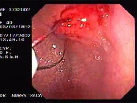 Polypectomy (2 of 6)