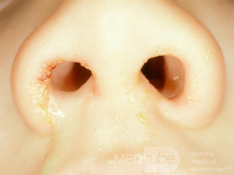 Nasal Foreign Body Unilateral Discharge