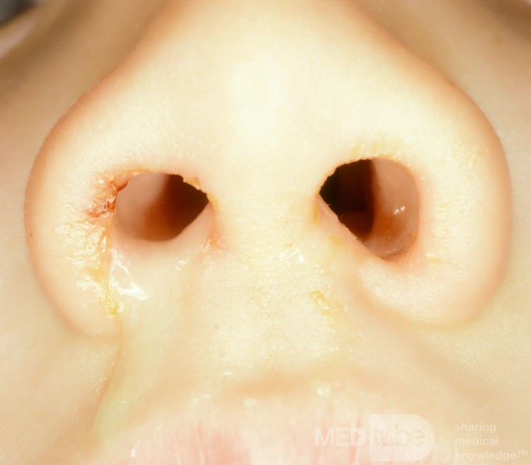 Nasal Foreign Body Unilateral Discharge