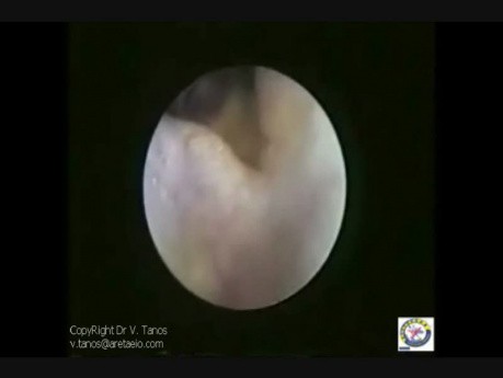 Trans-Vaginal Laparoscopy