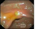 Gastric Ulcer Of The Lesser Curvature