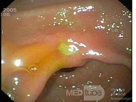 Gastric Ulcer Of The Lesser Curvature