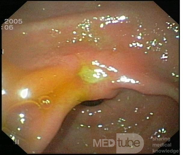 Gastric Ulcer Of The Lesser Curvature