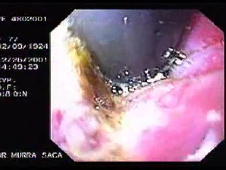 Hemorrhage due status post rubber band ligation of esophageal varices (5 of 25)