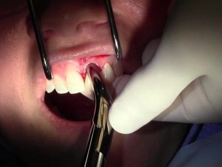 Atraumatic Extraction, II - Extraction #9 with GBR-Socket Grafting