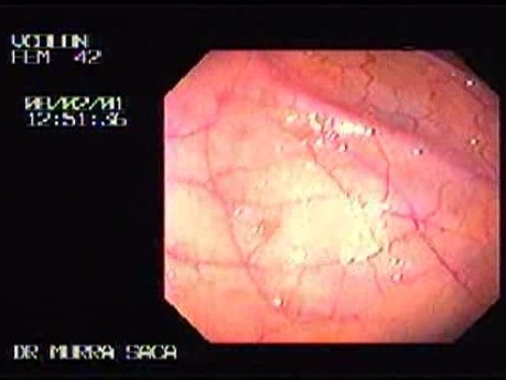 Lymphoid Hyperplasia