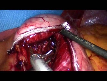 Laparoscopic Gastric Bypass - Part 4