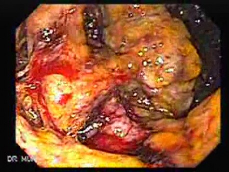 Toxic Dilatation Of The Colon Superimposed Pseudomembranous Colitis (9 z 17)