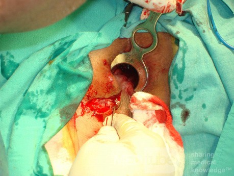 Fistula in Ano (7 of 7)