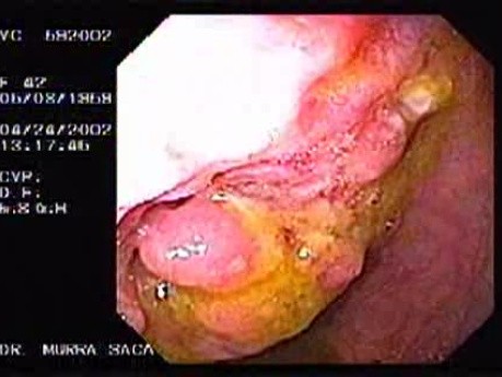 Crohn´s Disease (5 of 28)