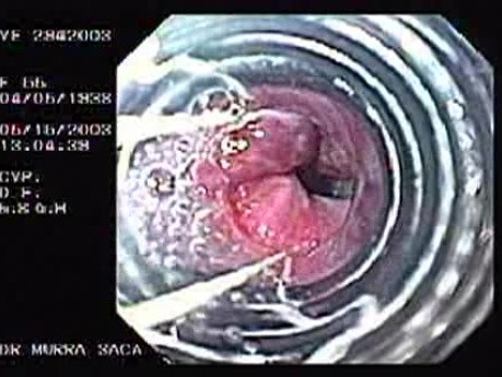 Banding of Esophageal Varices - View Through Banding Device