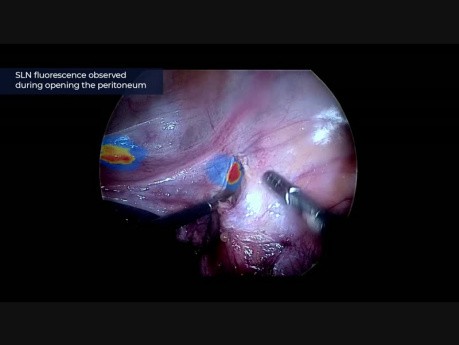 Laparoscopic, Lower Paraaortic Lymphadenectomy and Pelvic SLN Biopsy Using ICG Imaging in High-Risk Endometrial Cancer