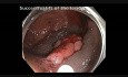 Cecum - Flat Lesion - EMR Steps: Injection-Resection-APC