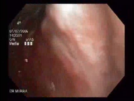 Adenocarcinoma of Cardia with Signet Ring Cells (2 of 6)