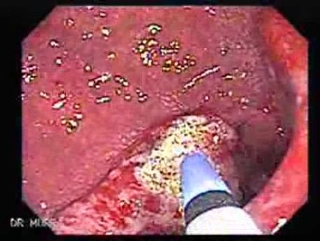 Multiple Adenomatous Polyps Of The Rectum (9 of 37)