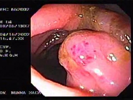 Zollinger- Ellison Syndrome - Gastric Ulcer with Gastrocolic Fistula (4 of 21)