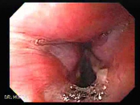 Laryngopharyngeal reflux (LPR) (1 of 2) - Granuloma