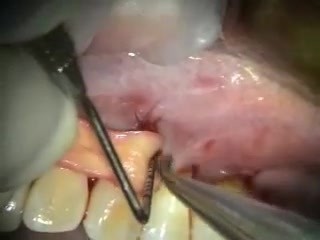 Grafting Upper Left