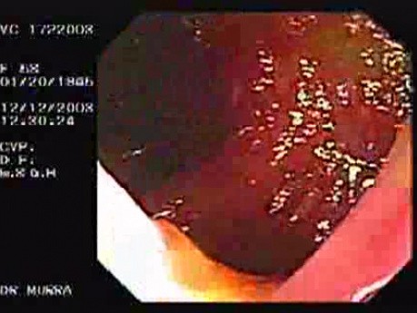 Unspecific Colitis due to Shigellosis (5 of 7)