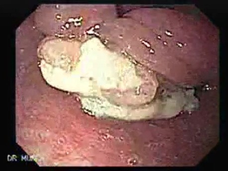 Esophageal Squamous Cell Carcinoma of the the upper third of the Esophagus that invades the subglotic (2 of 8)