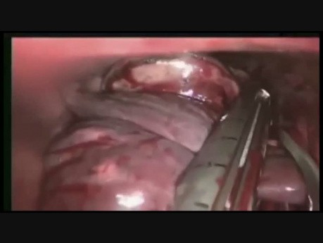 Lung Cancer Left Lower Lobectomy Fissureless Technique Single-Port VATS