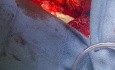 Lungless Patient on VA Awaiting for Transplant 