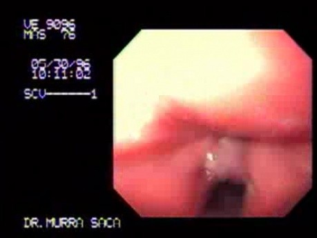Carcinoma of the larynx - genereal view