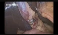Two Port Laparoscopic Cholecystectomy by Dr R K Mishra