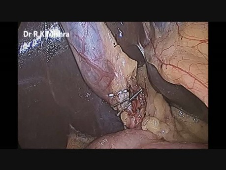 Two Port Laparoscopic Cholecystectomy by Dr R K Mishra