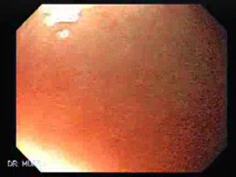 Gastrointestinal Stromal Tumor - GIST (4 of 13)