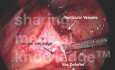 TAPP Dissection