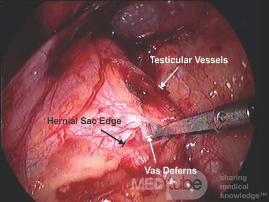 TAPP Dissection