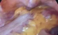 Left hemicolectomy in an obstructive descending colon tumor