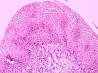 Glycogenic acanthosis