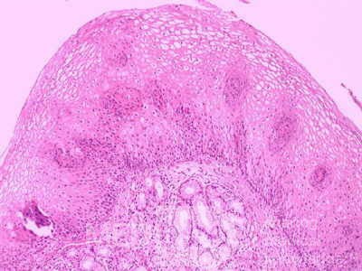 Glycogenic acanthosis