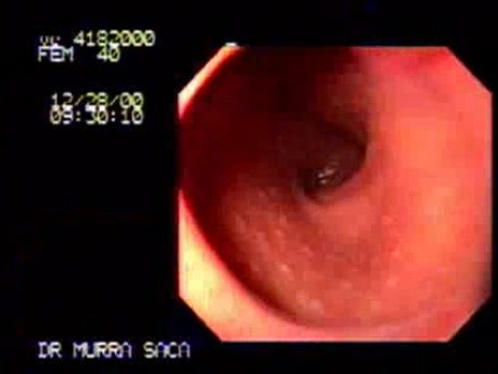 Brunner Gland Hyperplasia