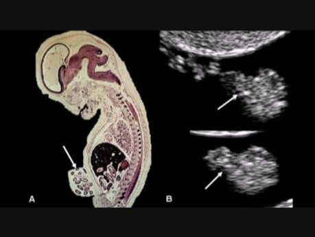 Normal Early Pregnancy as Seen on Ultrasound Scan
