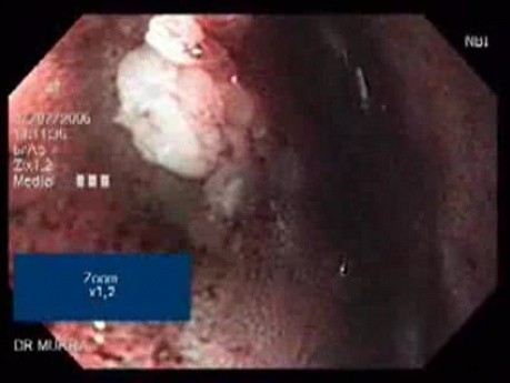 Gastric Erosion (2 of 3)